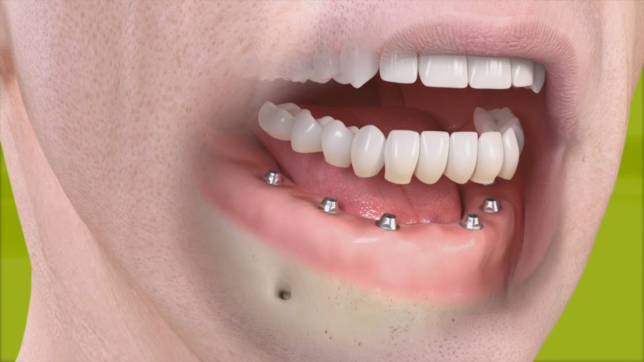 Straumann - Festsitzende Restauration mit 4&ndash;6 Implantaten