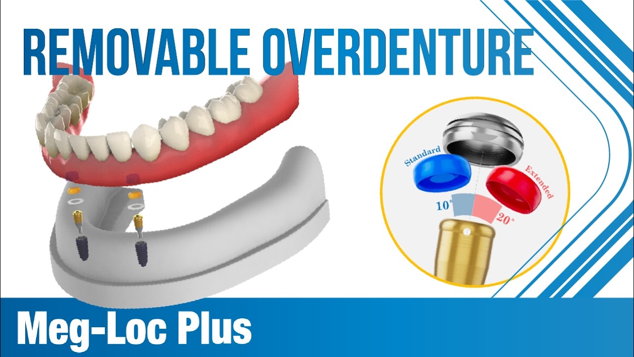 제대로 만든 Overdenture Solution, 'Meg-Loc Plus'