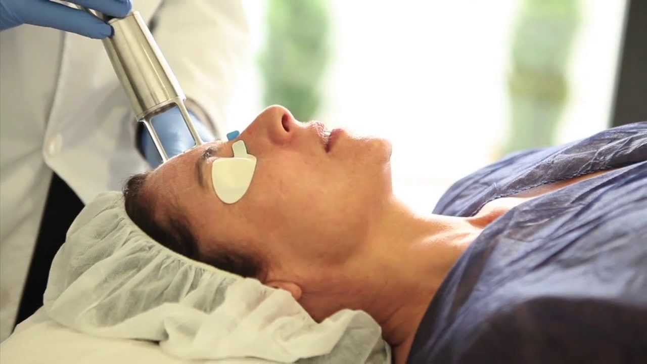 Tratamiento Laser co2 fraccionado, Carmen Sarmiento Sevilla