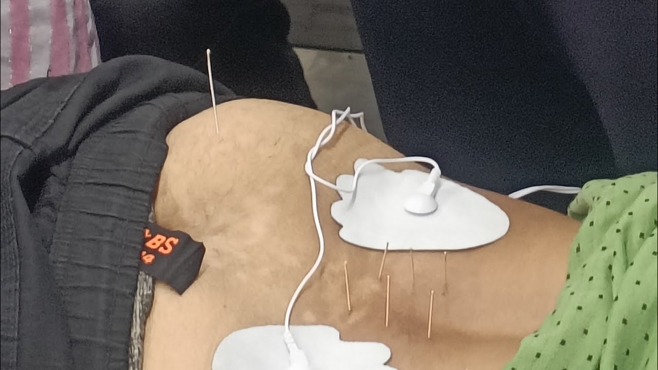LUMBER DRY NEEDLING LIVE WORKSHOP☎️9433481024 for home treatment 