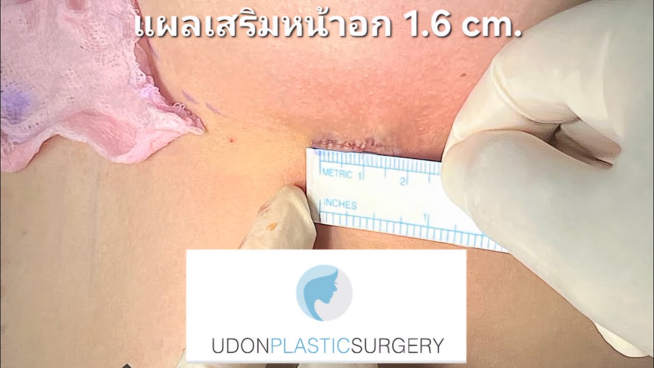 #เสริมหน้าอกแผลเล็ก