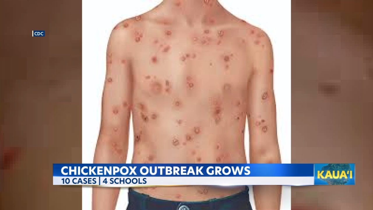 Kauai chickenpox outbreak increases to 10 cases across 4 schools