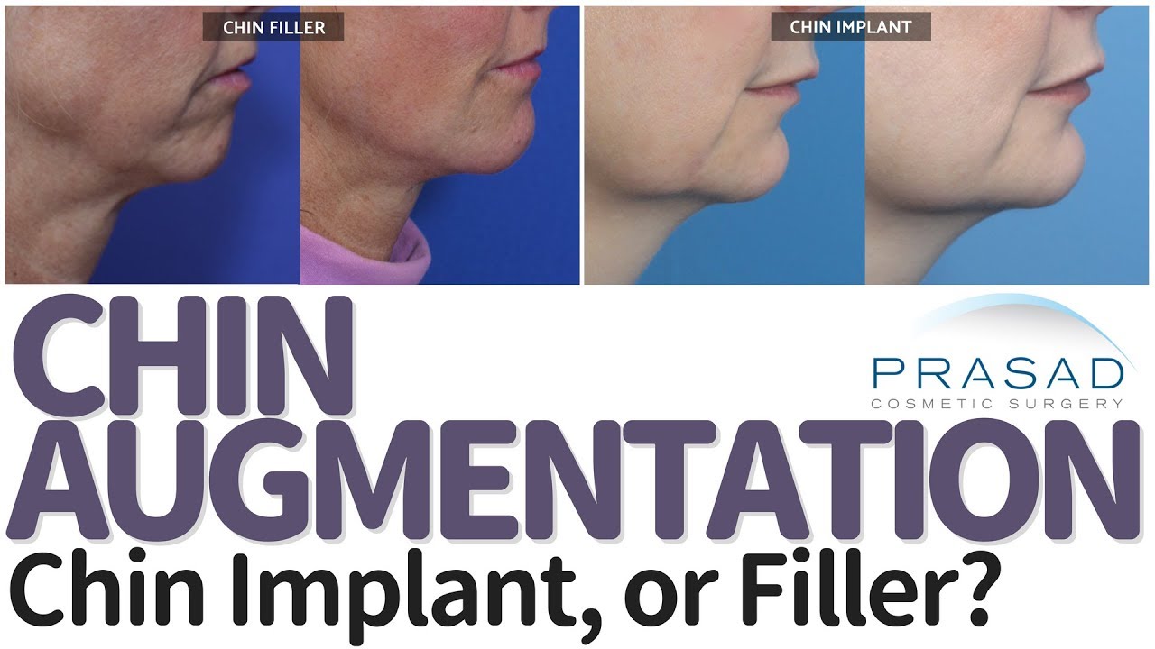 Pros and Cons of Chin Implants and Chin Fillers