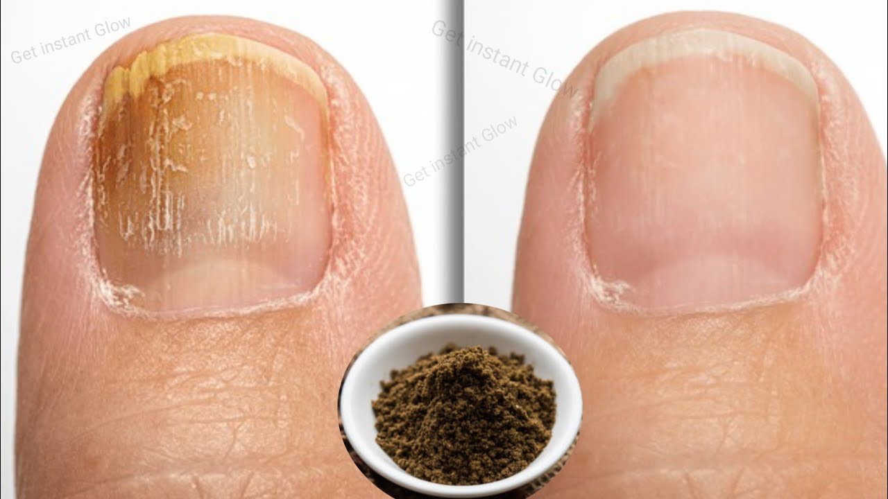 Nail fungus treatment at home | Nail whitening at home | Say GOODBYE to Nail Fungus with Clove Packs