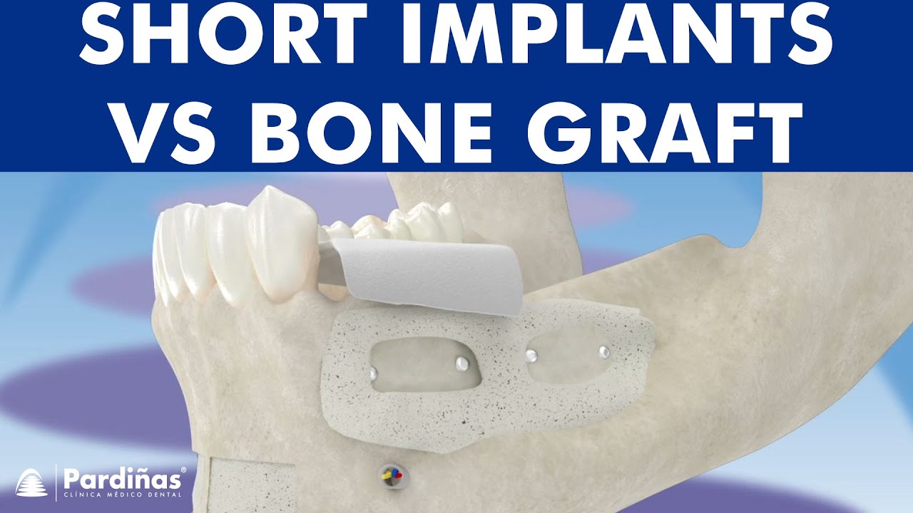 Short implants and bone augmentation &copy;