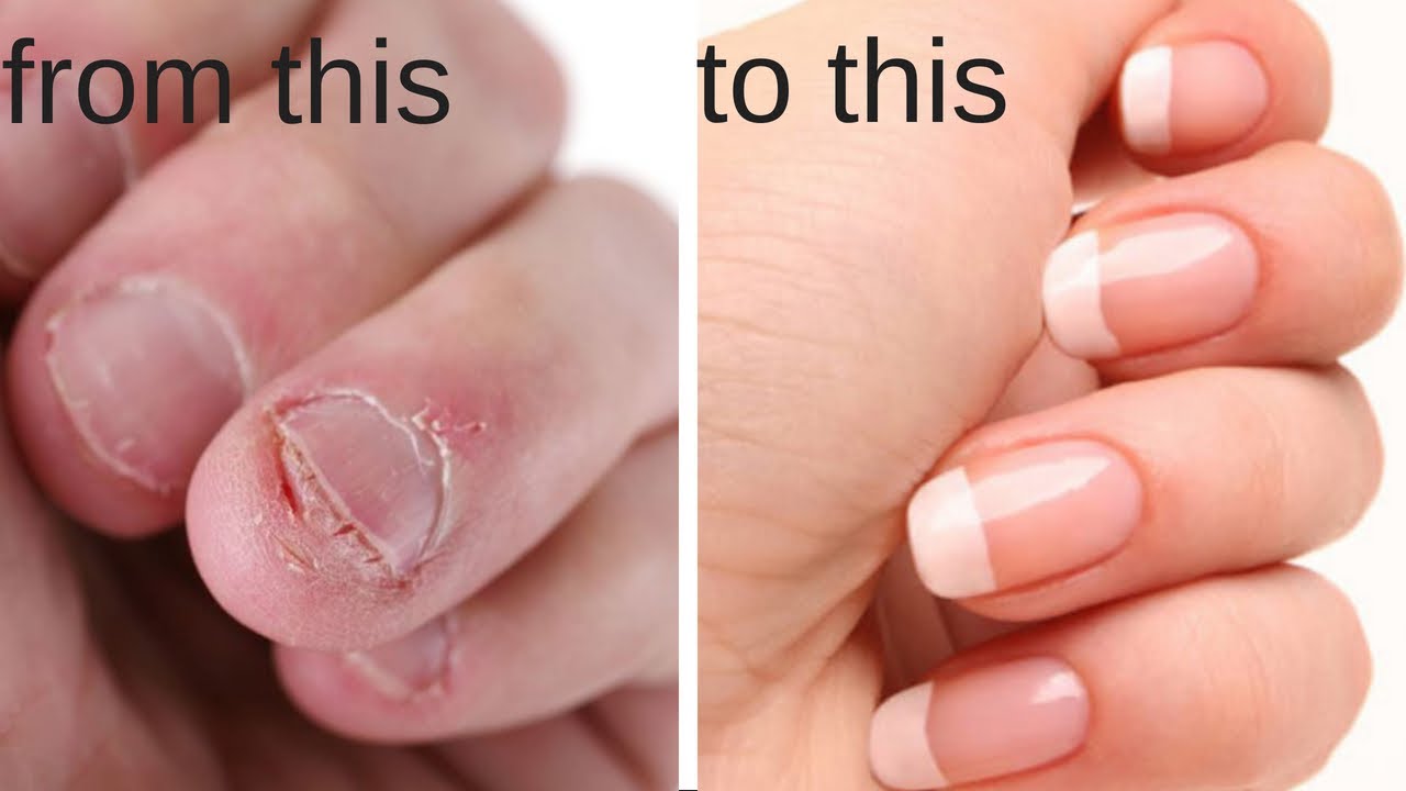 How to Stop Biting Your Nails ★ Break The Habit Permanently