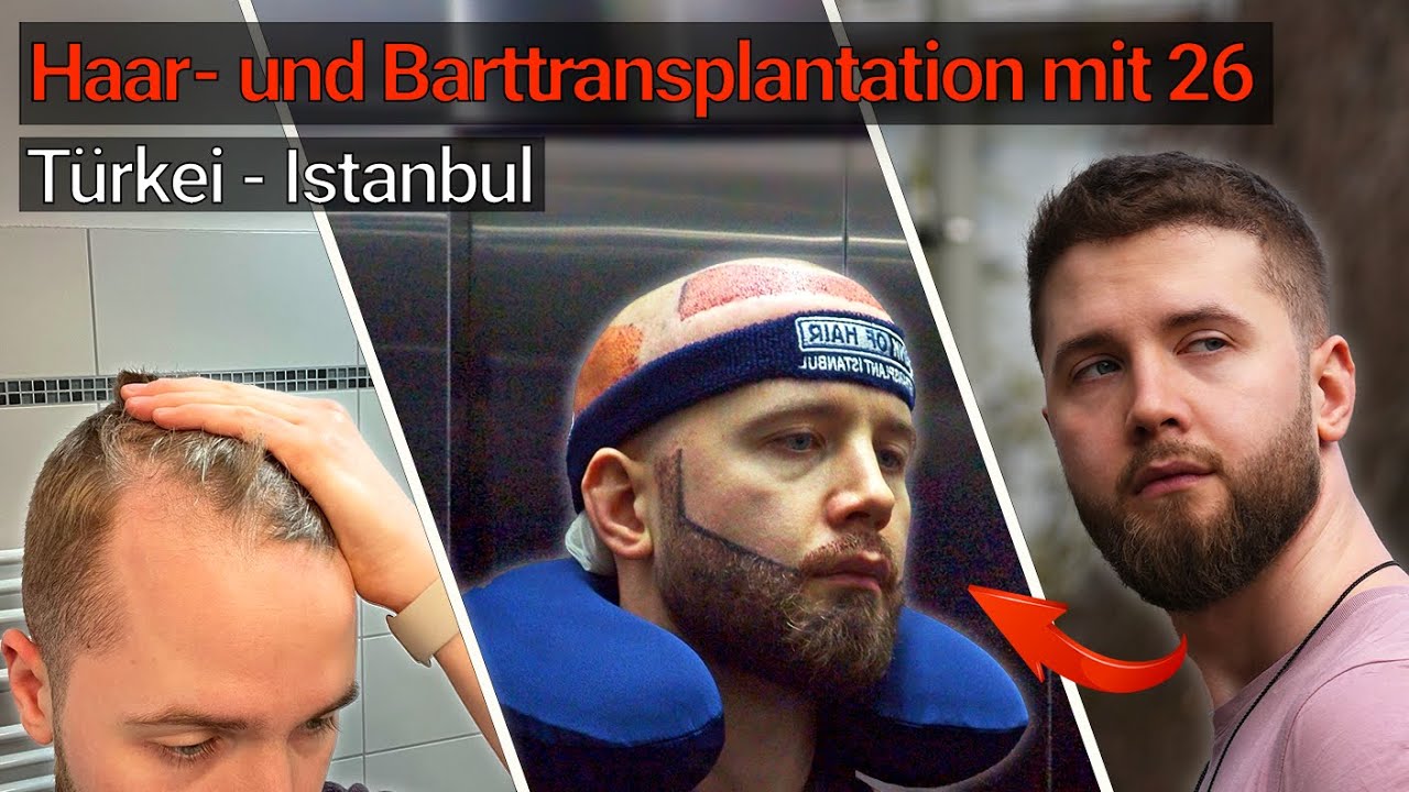Haar- & Barttransplantation Istanbul - Klappt die OP? | MichaelInDev
