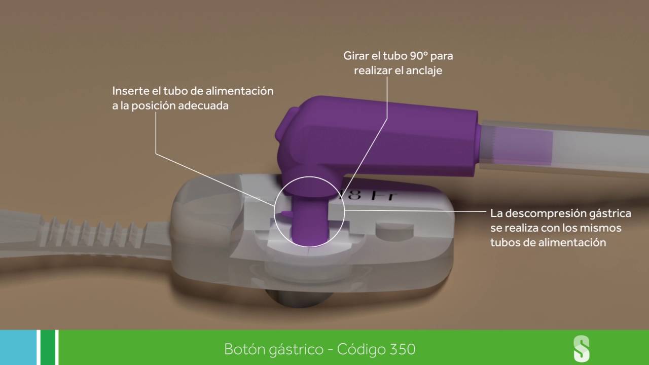 Botón gástrico Silmag_ Cód. 350