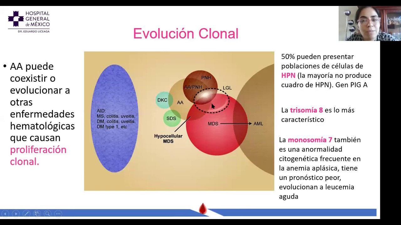Anemia Aplásica