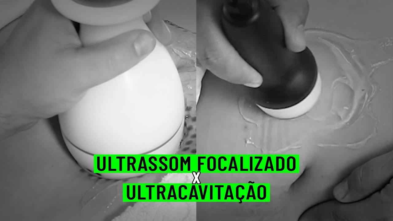 Ultrassom focalizado X ultracavitação
