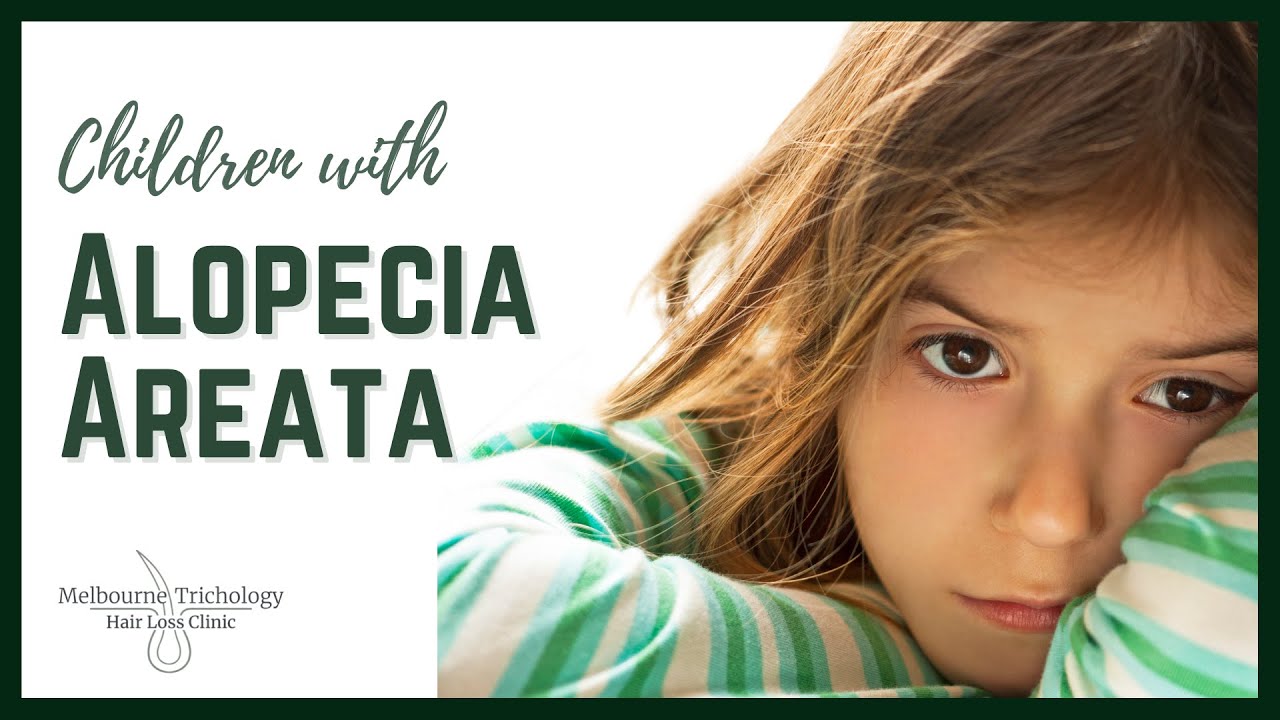 Children with Alopecia Areata