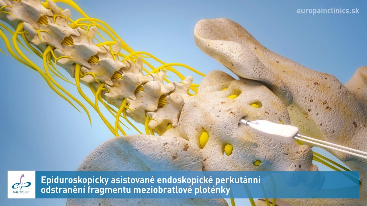 Epiduroskopicky asistované endoskopické perkutánní odstranění fragmentu meziobratlové ploténky