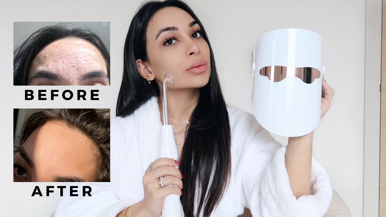 HOW I CLEARED MY SKIN | Fungal acne, rosacea, bumps