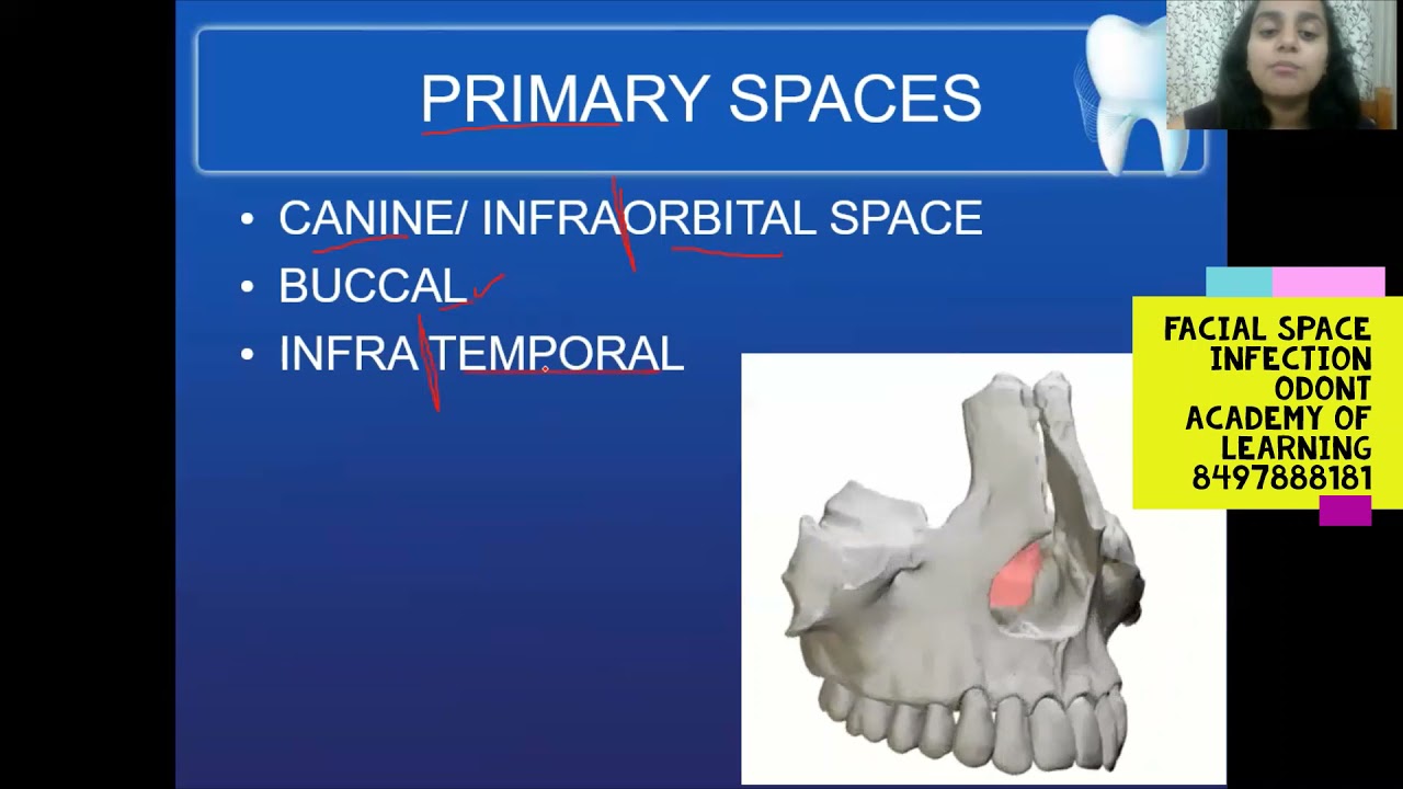 FACIAL SPACE INFECTION