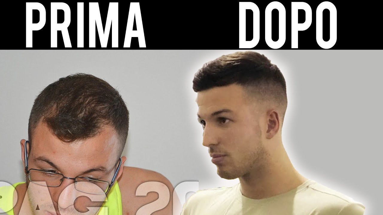 PERDI I CAPELLI? TI AIUTO IO - ALOPECIA ANDROGENETICA (la mia esperienza)