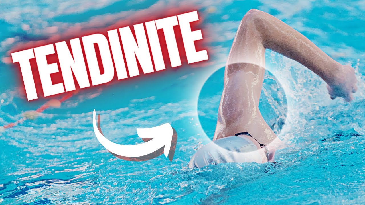 LES TENDINITES EN NATATION (Comment les éviter, les guérir etc ...)