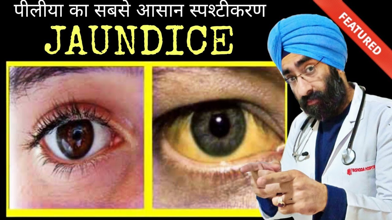 पीलीया क्यों होता है | Jaundice Best Explanation - Cause to Cure | Dr.Education (Hindi)