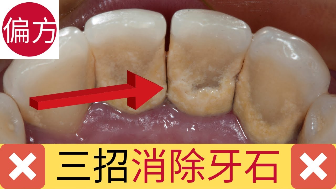 純天然牙石去除法