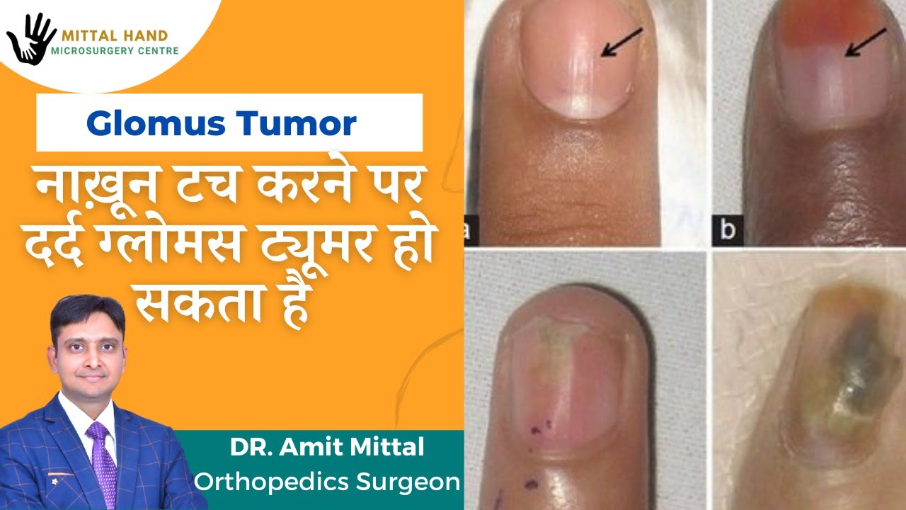उंगली के नाख़ून के पास होने वाला तेज़ दर्द। Glomus Tumor In Hindi | नाख़ून टच करने पर चीख निकल जाना  |