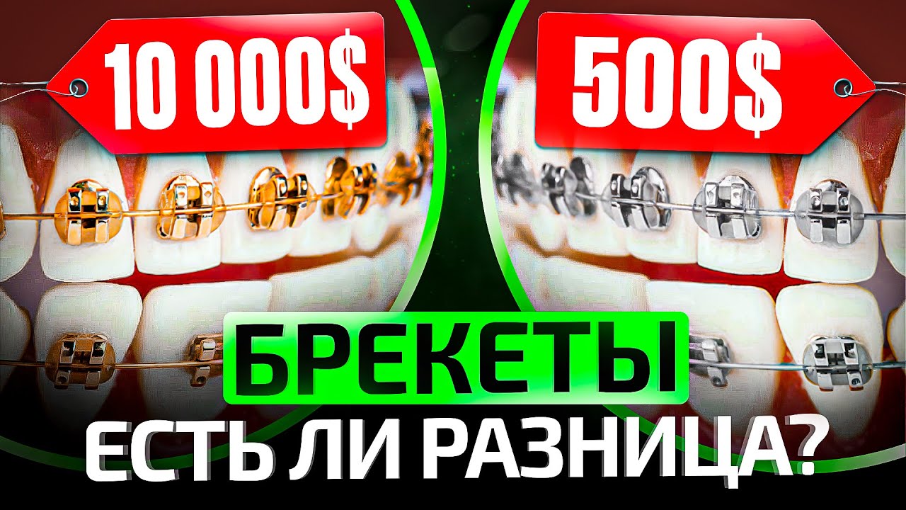 Самые дешевые и самые дорогие БРЕКЕТЫ — есть ли смысл переплачивать?