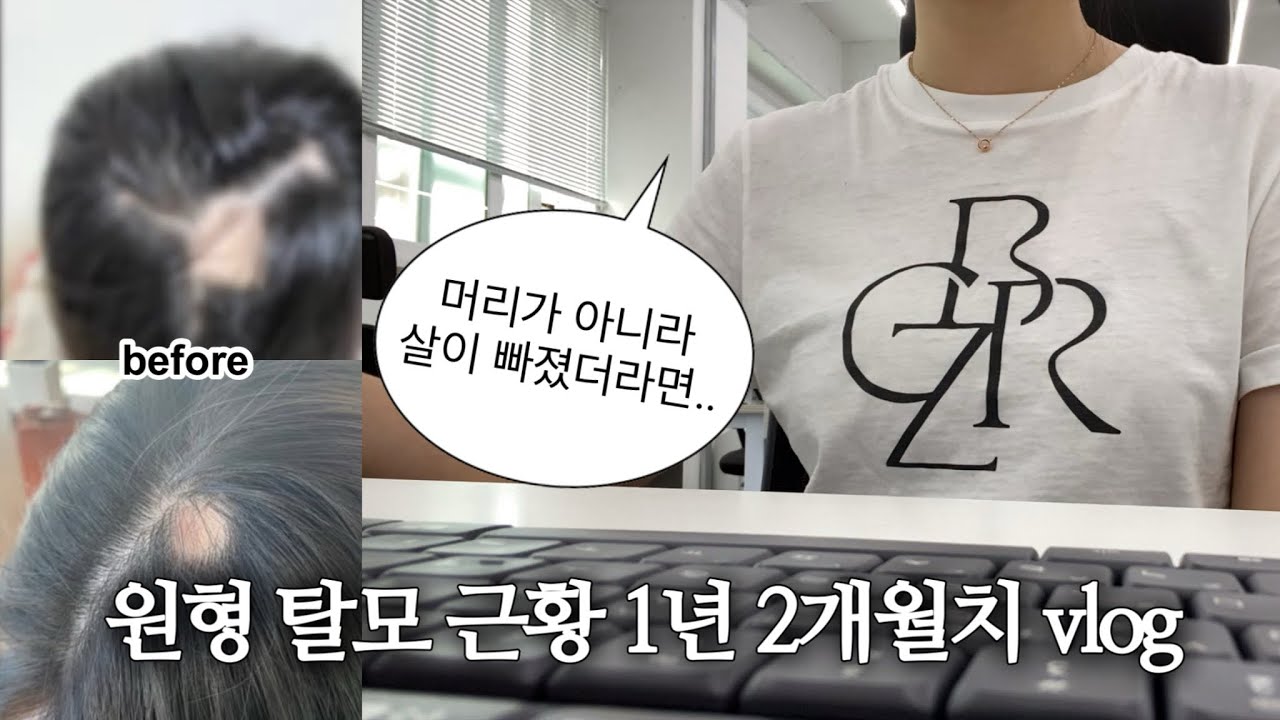 제 최근 원형탈모 근황은요…vlog / 20대 여자 원형탈모 후기, 아직 극복중💫