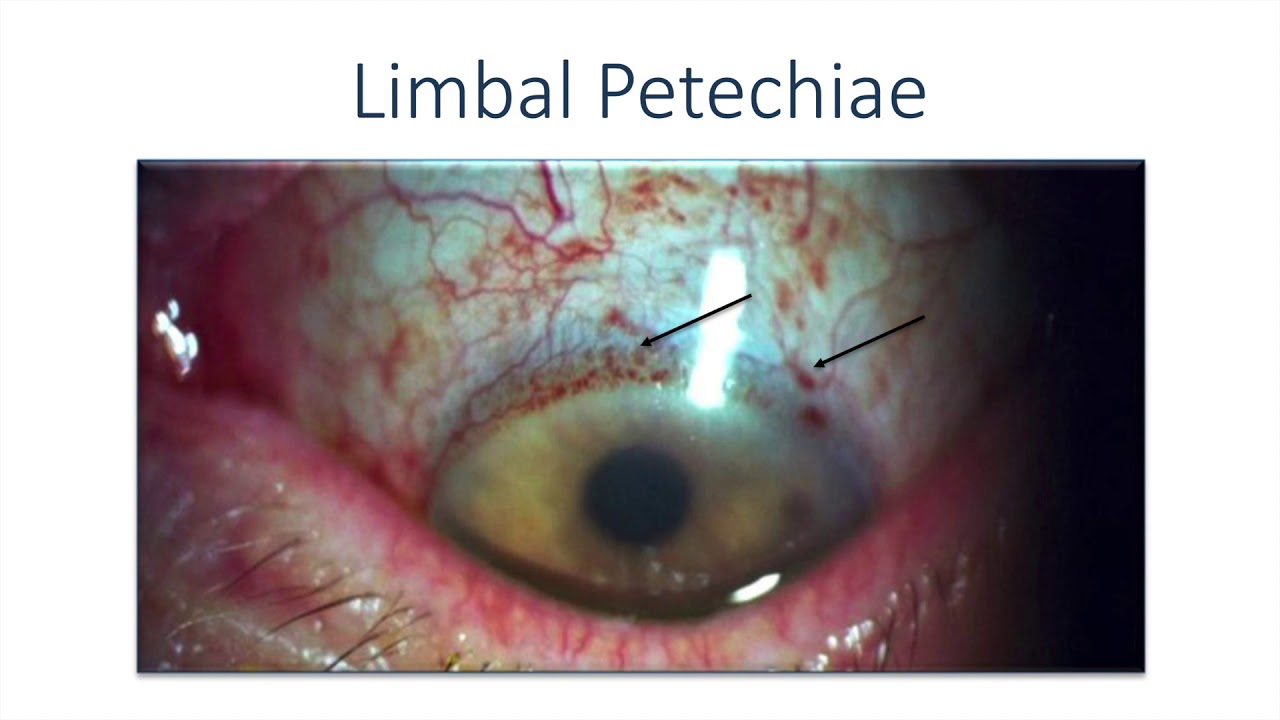 New Medications in the Pipeline for the Treatment of Glaucoma (Malik Y.  Kahook, MD)