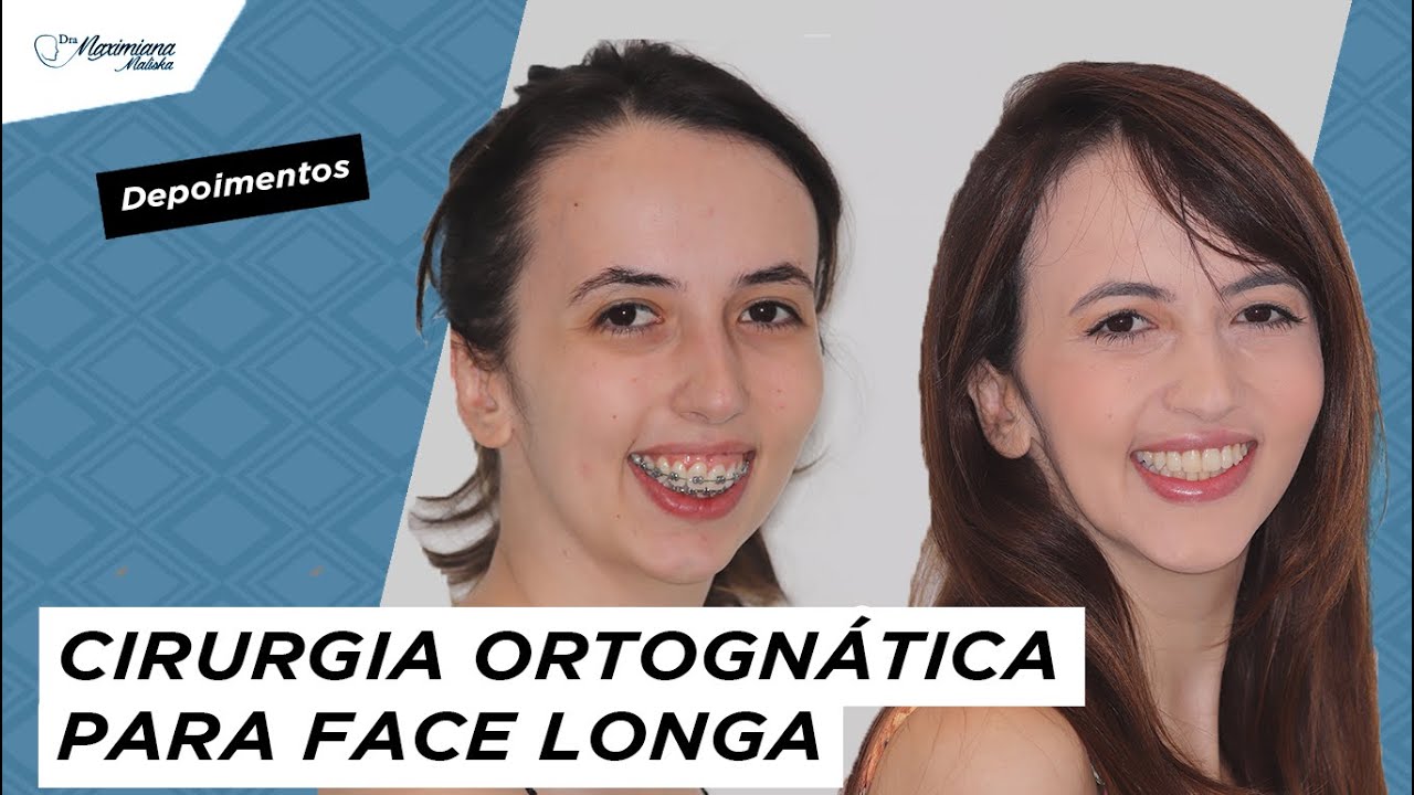 DEPOIMENTO CIRURGIA ORTOGNÁTICA | Face longa e Classe II