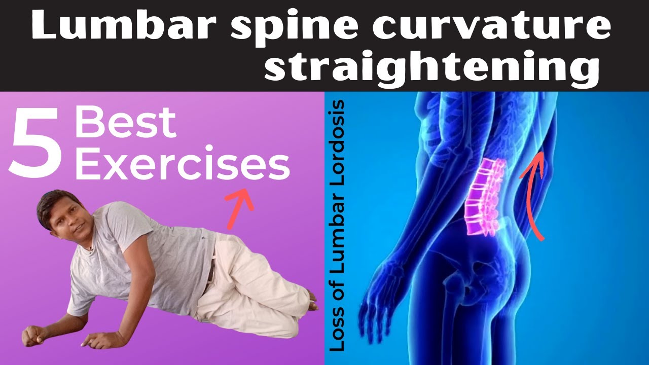 5 Best Loss of Lumbar Lordosis Correction Exercises| Lumbar spine curvature exercise