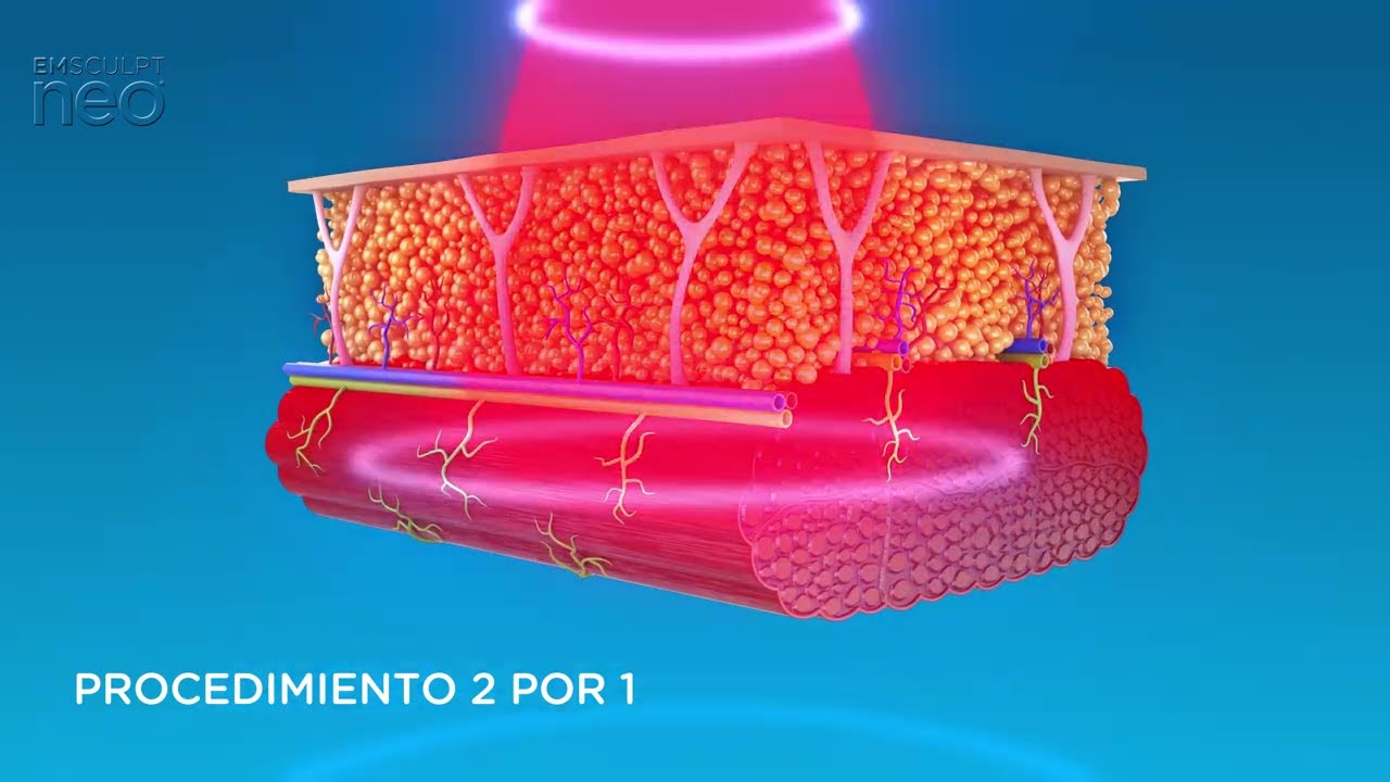 ¿Cómo funciona EMSCULPT NEO para tonificar la musculatura?