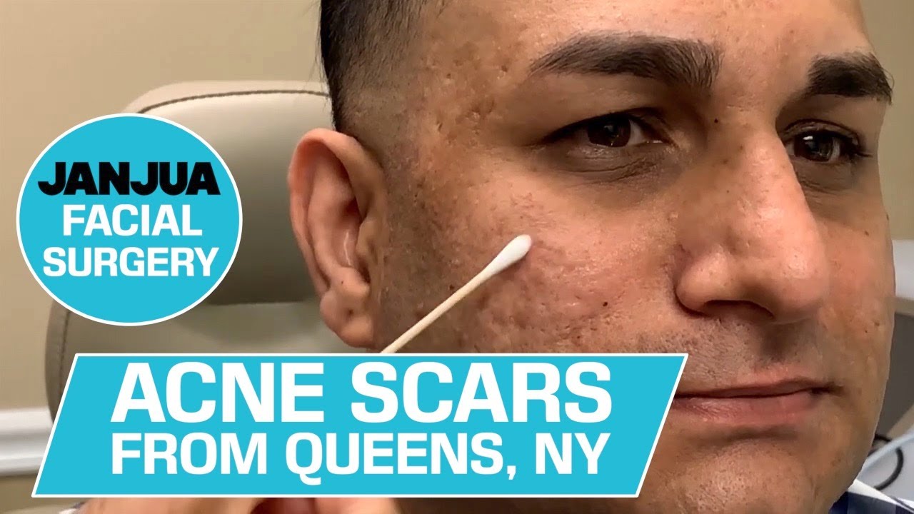ACNE SCARS FROM QUEENS, NEW YORK - DR. TANVEER JANJUA - NEW JERSEY