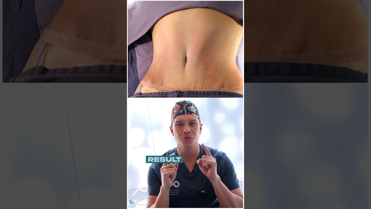 Resultado Abdominoplastia / Tummy Tuck