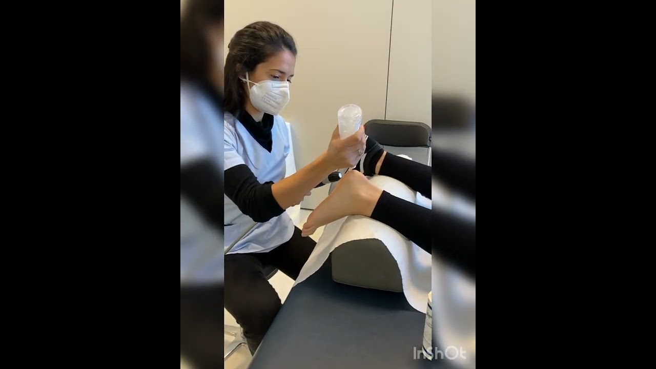 Ondas de choque para espol&oacute;n calc&aacute;neo