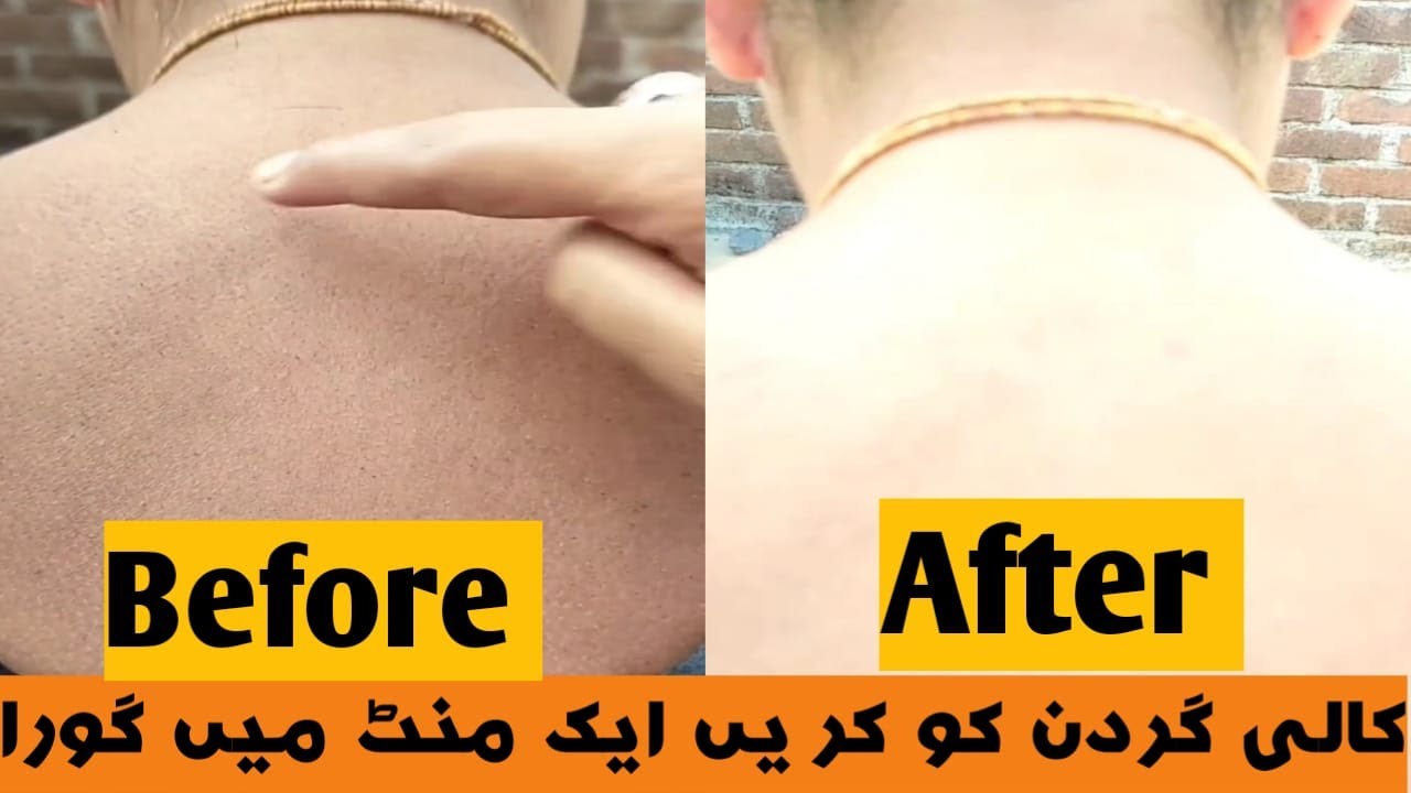 DARK NECK SOLUTION| GET FAIR NECK IN FEW MINUTES| Acanthosis Nigricans Solution | FATIMA BEAUTY TIPS