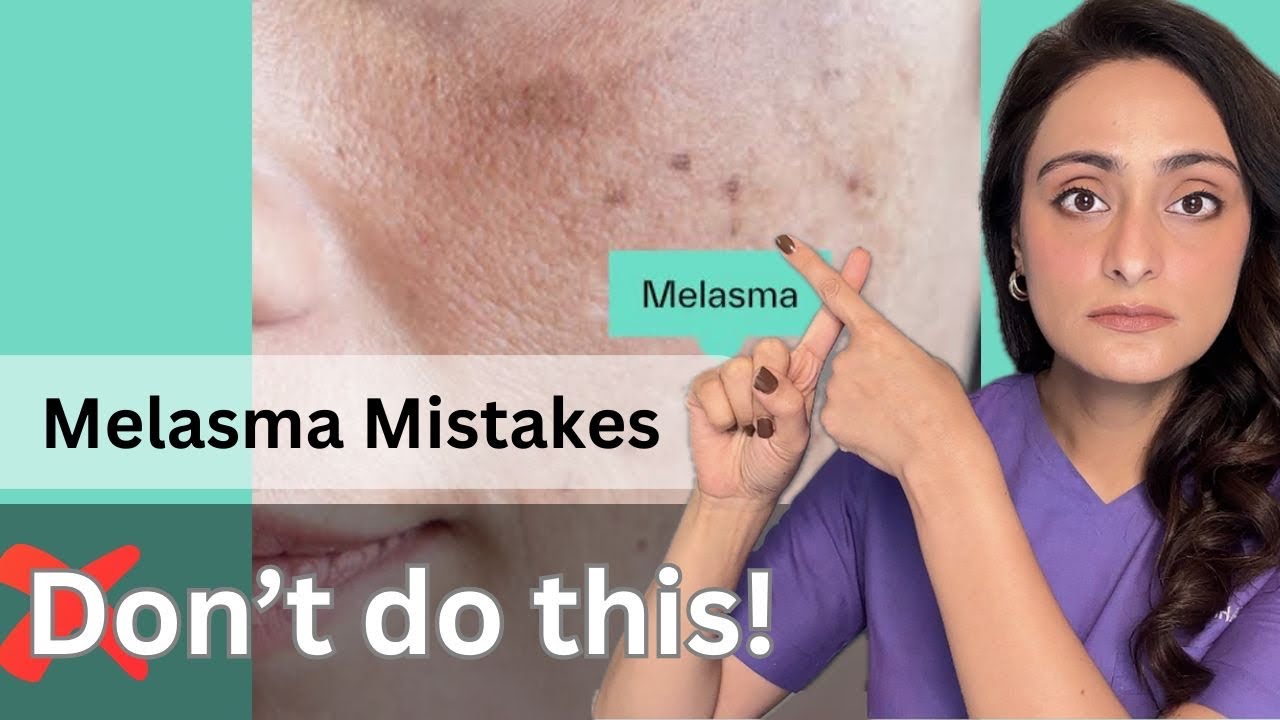 Melasma | Common mistakes | How to treat | Dermatologist