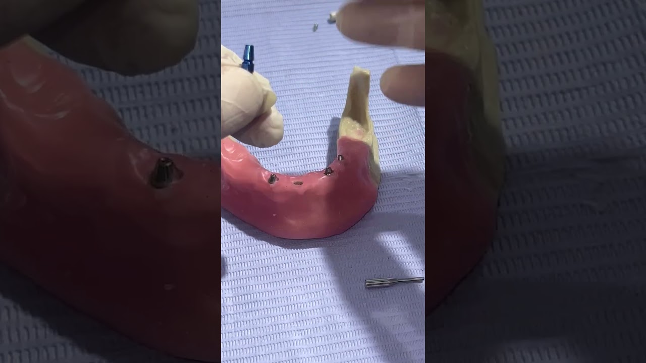 Different between multiunit abutment and implant abutment and their accessories in dental implants