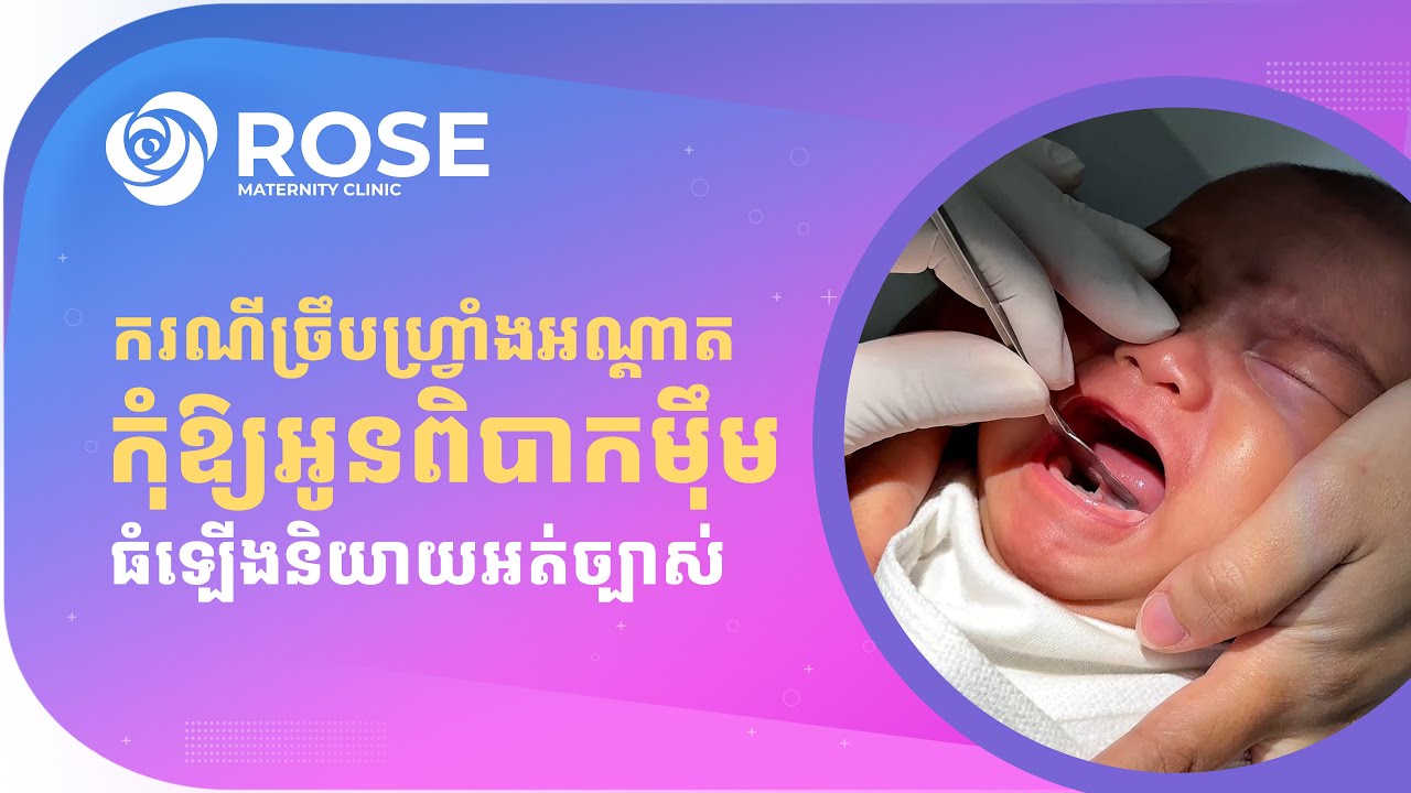 ករណីច្រឹបហ្វ្រាំងអណ្ដាត កុំឱ្យអូនពិបាកម៉ឹម ហើយធំឡើងនិយាយអត់ច្បាស់