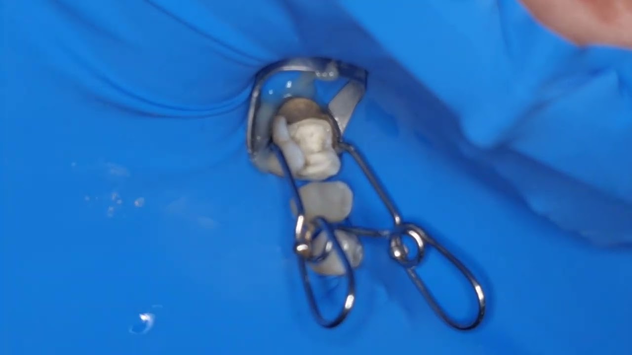اصلاح الربرادام مع بناء كومبوزيت وتثبيت saddle matrix