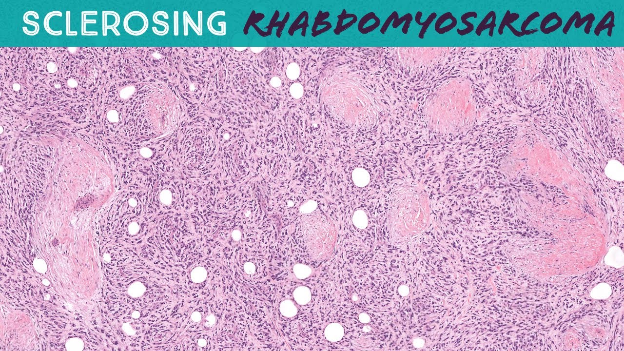 Sclerosing Rhabdomyosarcoma (soft tissue pathology sarcoma)