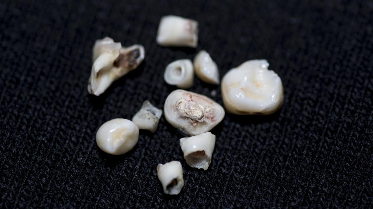 Bank Baby Teeth for Stem Cells?