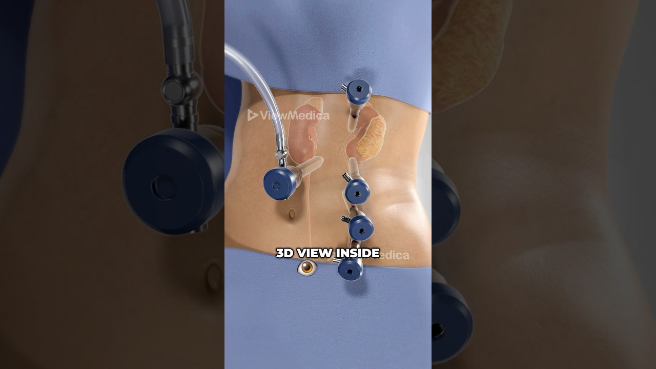 Robot-Assisted Human Kidney Removal (3D Animation)