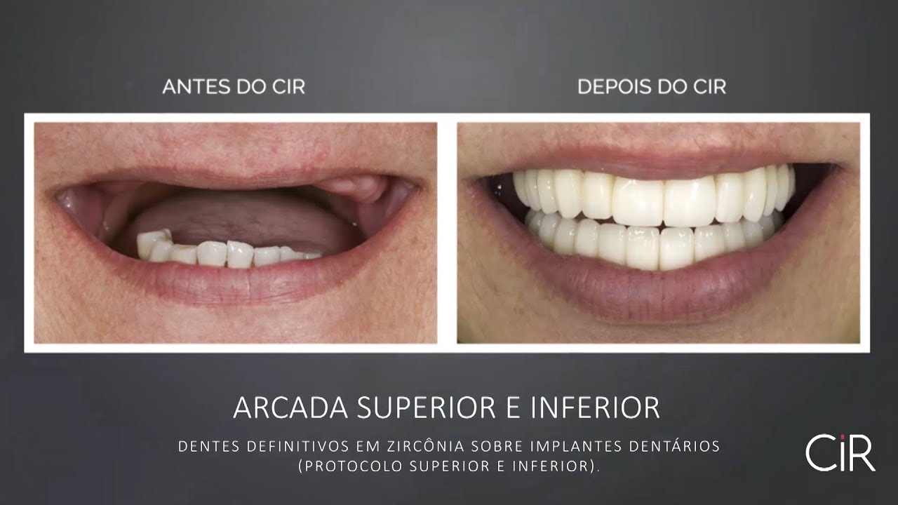 Antes e Depois - Implante Dentário (Protocolo )
