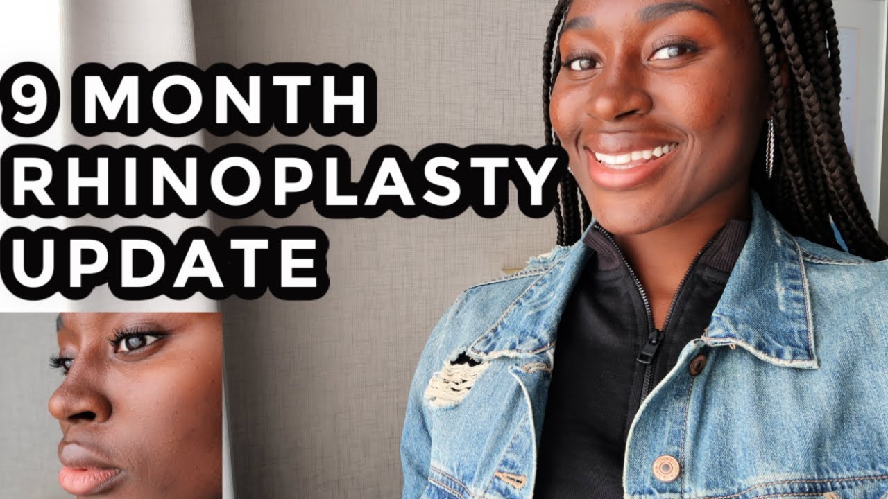 9 MONTH RHINOPLASTY UPDATE | Dr. OK Bora | Jessica's Area