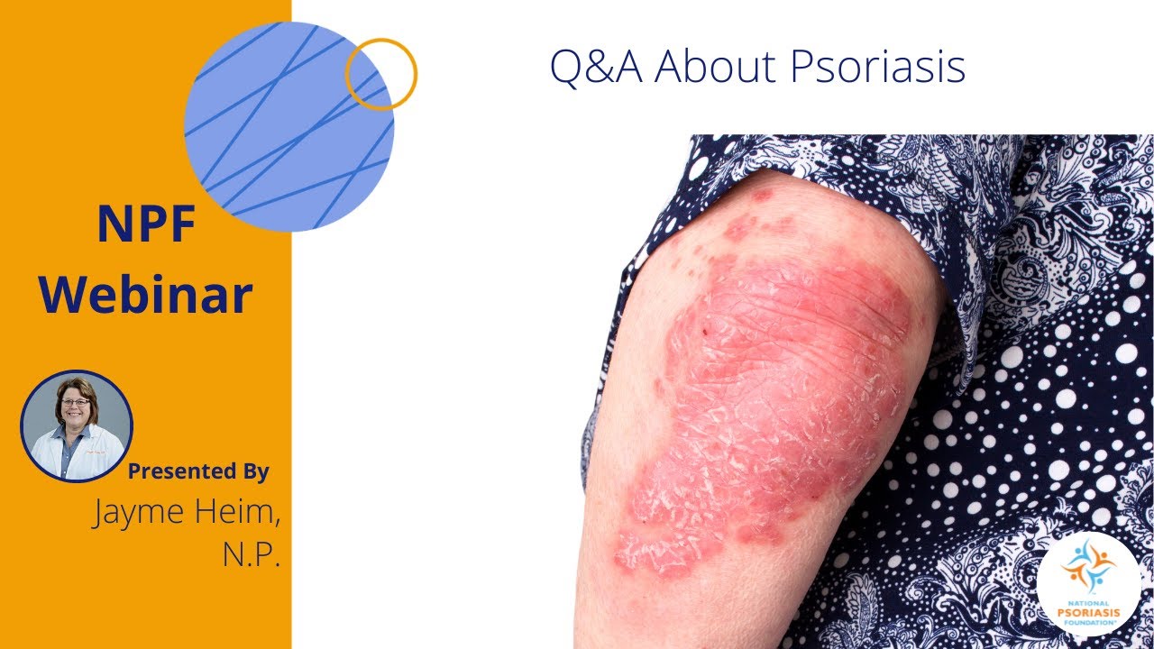 Q&A About Psoriasis
