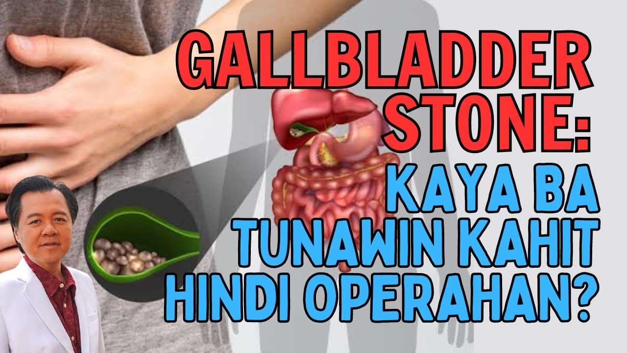 Gallbladders Stones: Kaya Ba Tunawin Kahit Hindi Operahan?