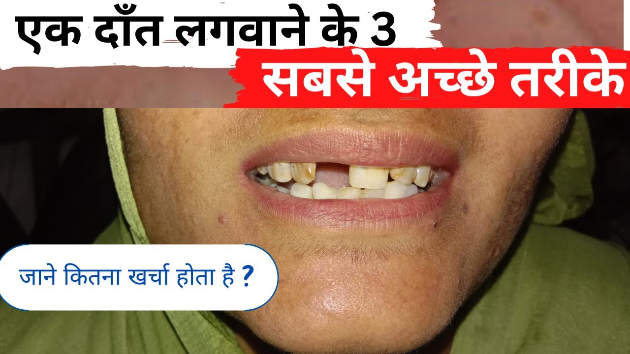 What Is The 3 Best Option To Replace Single Tooth |सामने वाले एक दाँत लगाने में कितना खर्चा आता है ?