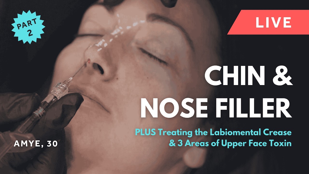 GEM&copy; Clinic 💎 Live Chin & Nose Filler Plus Treating the Labiomental Crease & Upper Face Toxin
