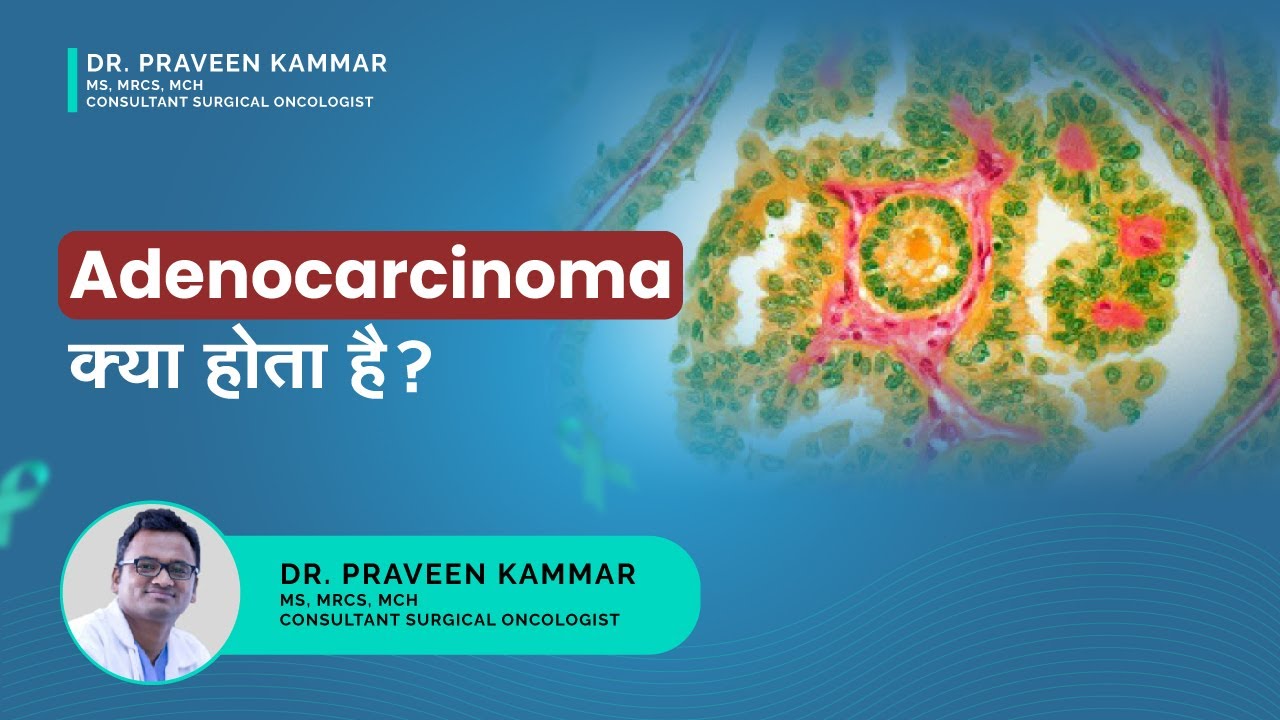 What is Adenocarcinoma? In which part of the body does it occur? Dr. praveen kammar