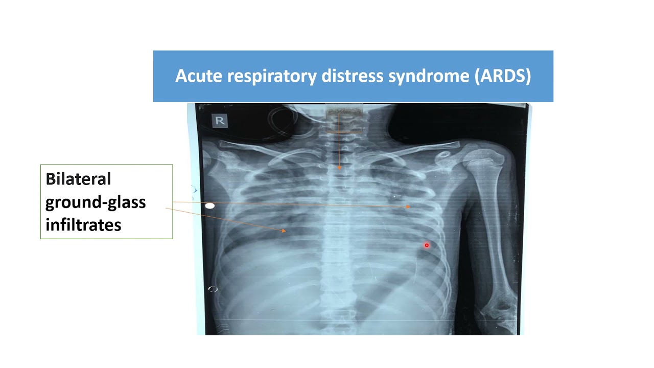 Chest X-Ray (Lung) | Pediatrics