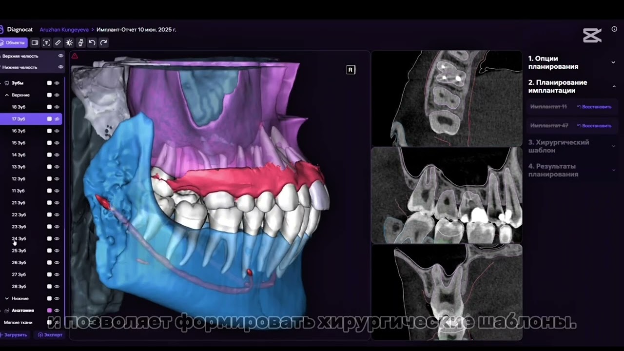 3D Dental предоставляет Искусственный интеллект в стоматологической диагностике (c Implant Studio)