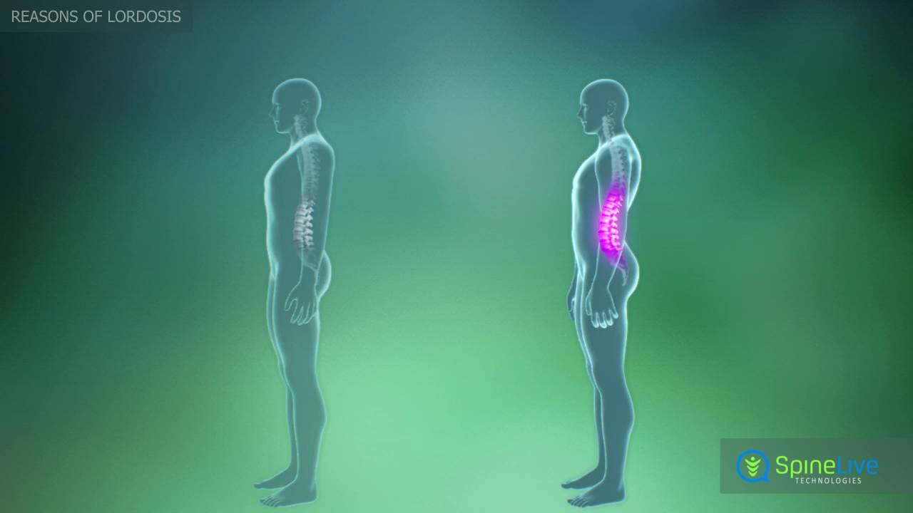 Lordosis. Reasons